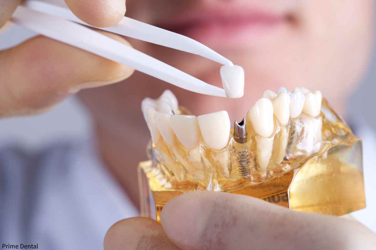 Are Dental Implants Right for You? A Complete Guide